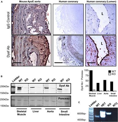 Effect of Dysferlin Deficiency on Atherosclerosis and Plasma Lipoprotein Composition Under Normal and Hyperlipidemic Conditions